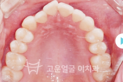 치료후기 이미지